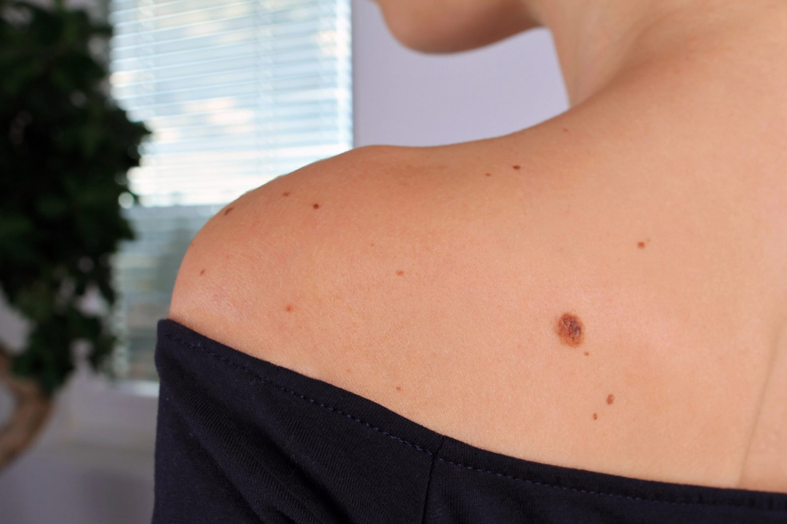 Odločitev za odstranjevanje znamenj je najboljša preventiva